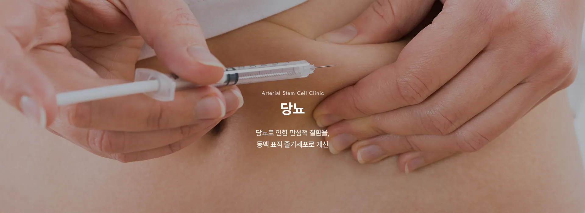 Arterial Stem Cell Clinic · 당뇨 · 당뇨로 인한 만성적 질환을, 동맥 표적 줄기세포로 개선