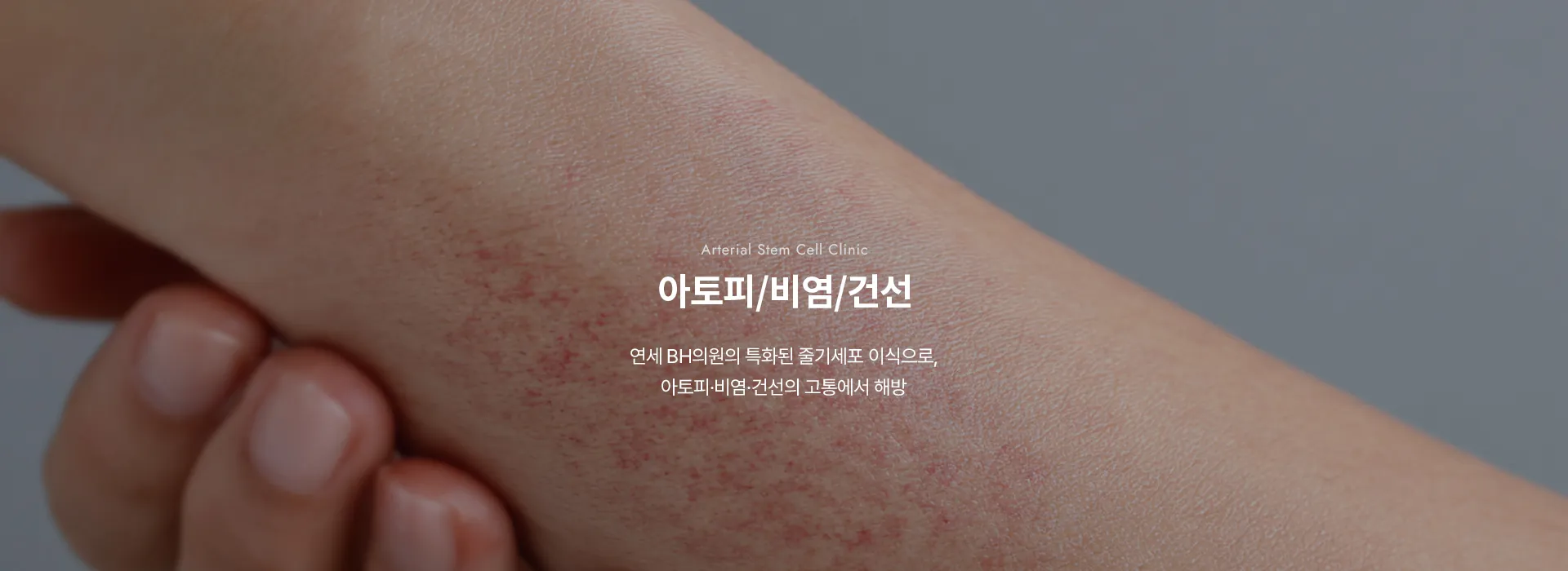 Arterial Stem Cell Clinic · 아토피/비염/건선 · 연세 BH의원의 특화된 줄기세포 이식으로, 아토피·비염·건선의 고통에서 해방