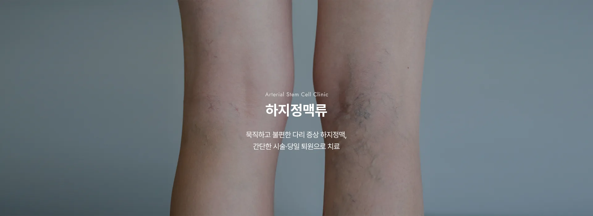 Arterial Stem Cell Clinic · 하지정맥류 · 묵직하고 불편한 다리 증상 하지정맥, 간단한 시술·당일 퇴원으로 치료