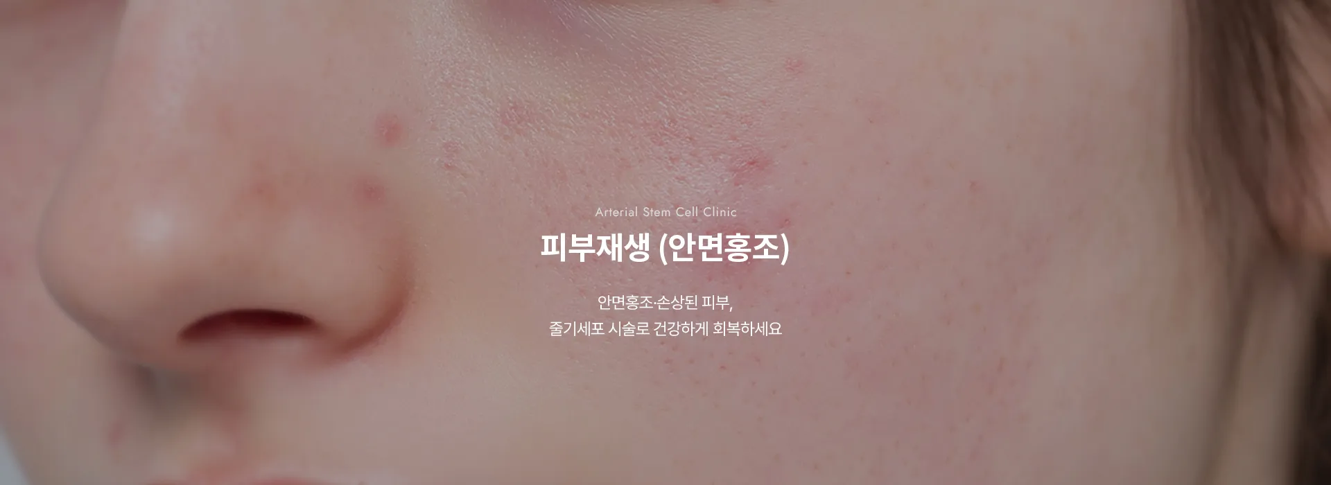 Arterial Stem Cell Clinic · 피부재생 (안면홍조) · 안면홍조·손상된 피부, 줄기세포 시술로 건강하게 회복하세요