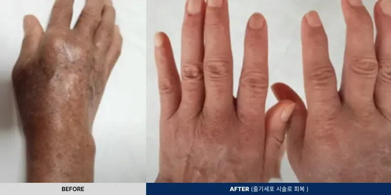 연세BH의원의 손가락 관절염 치료