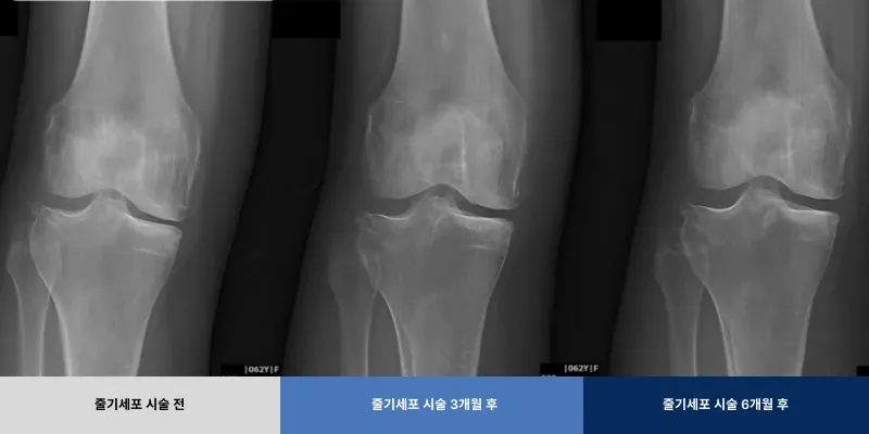 연세BH의원의 무릎 관절염 치료