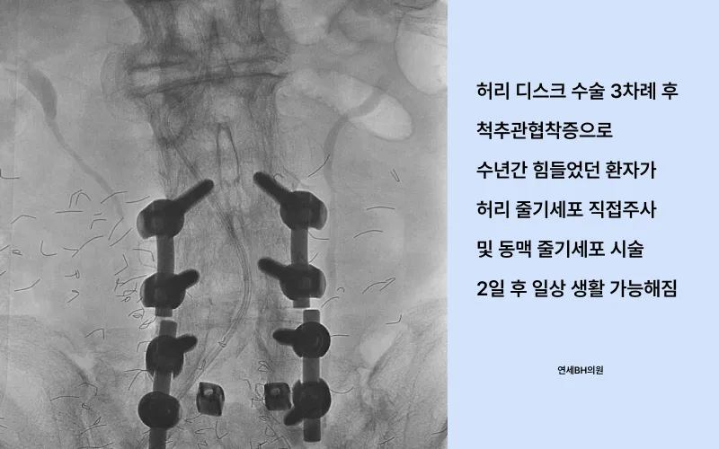 연세BH의원의 척추관 협착증 치료