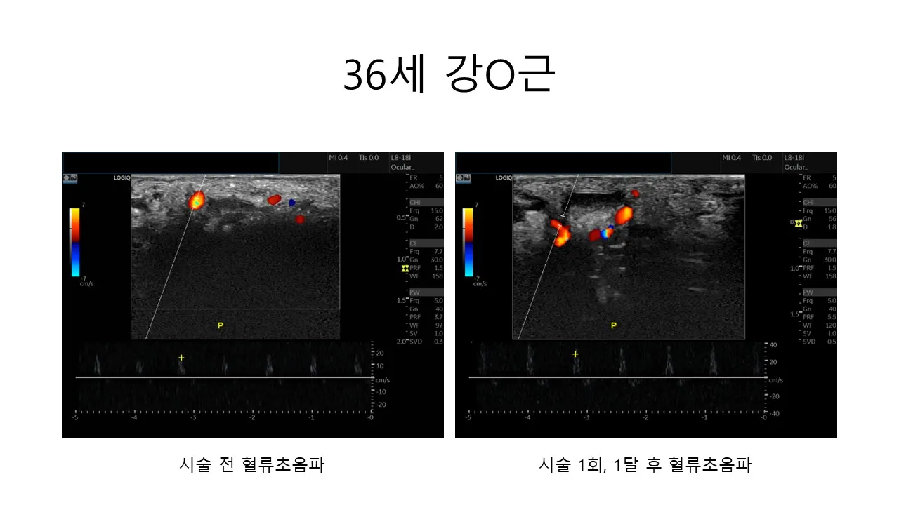 발기부전 시술 전후 사진