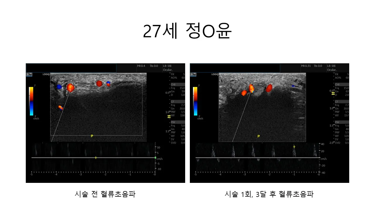 발기부전 시술 전후 사진