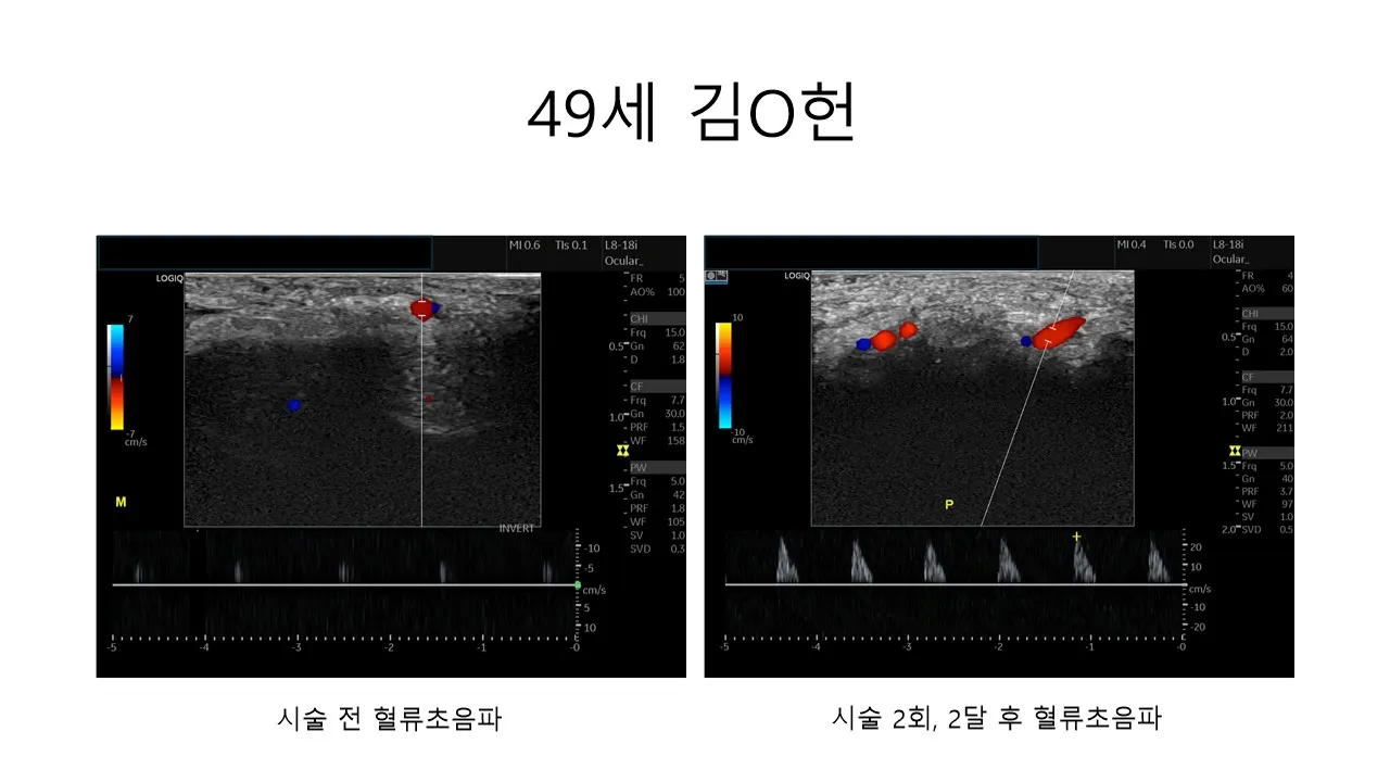 발기부전 시술 전후 사진