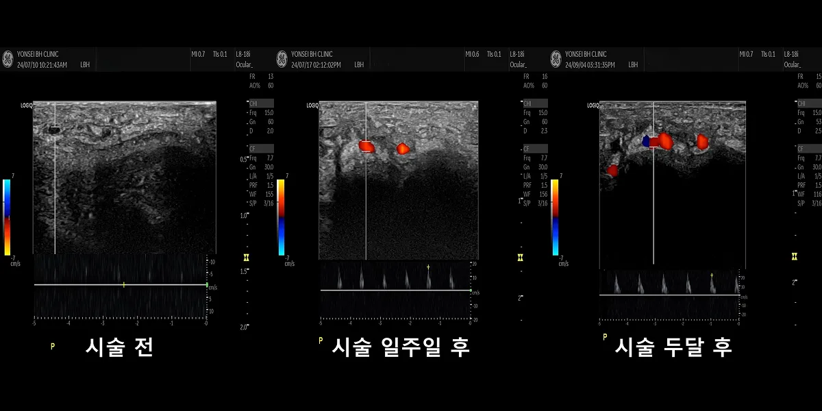 발기부전 치료 시술 전후