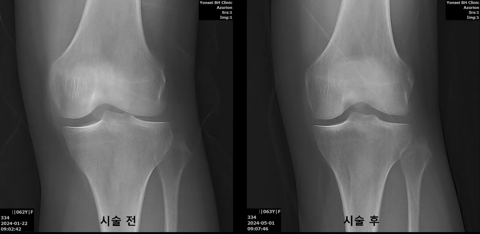무릎 관절염 치료 시술 전후
