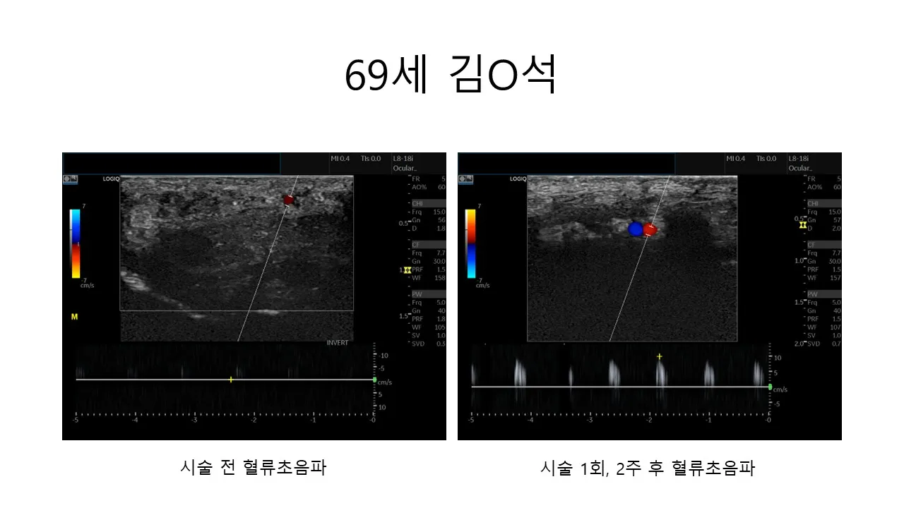발기부전 시술 전후 사진