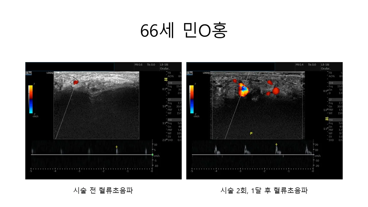발기부전 시술 전후 사진