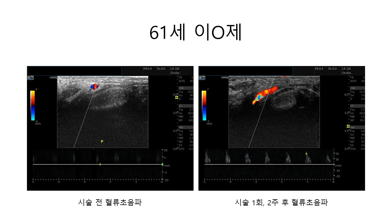 발기부전 시술 전후 사진