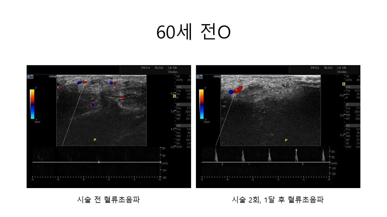 발기부전 시술 전후 사진