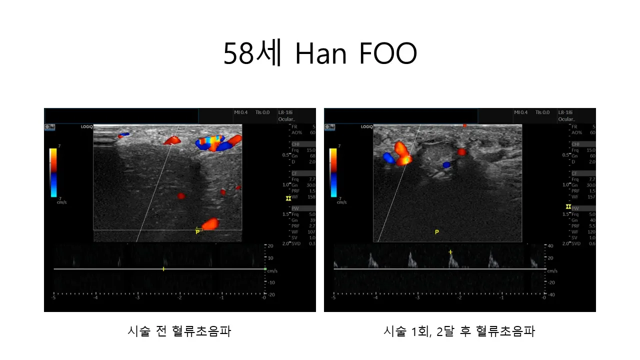 발기부전 시술 전후 사진