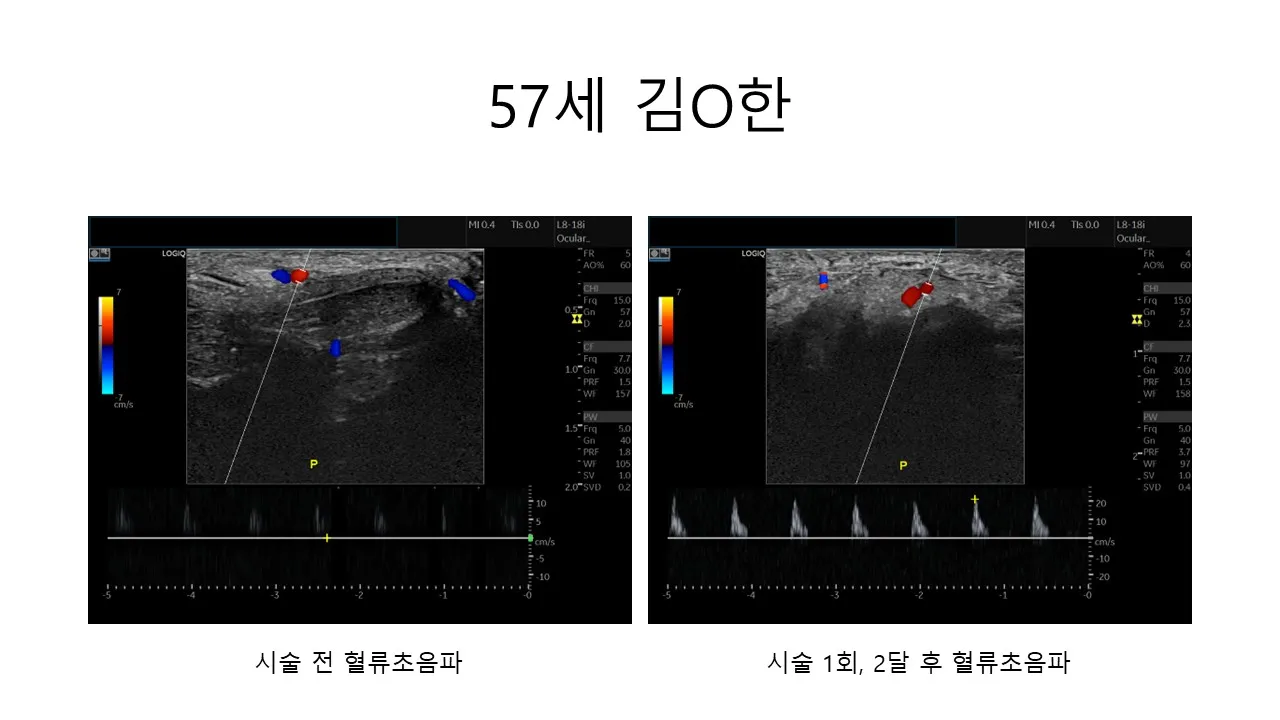 발기부전 시술 전후 사진