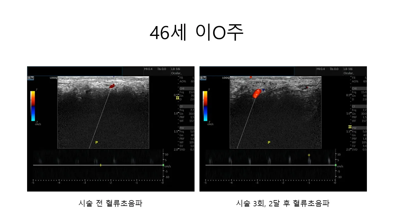 발기부전 시술 전후 사진