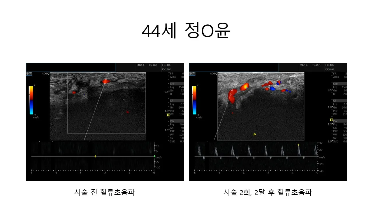 발기부전 시술 전후 사진