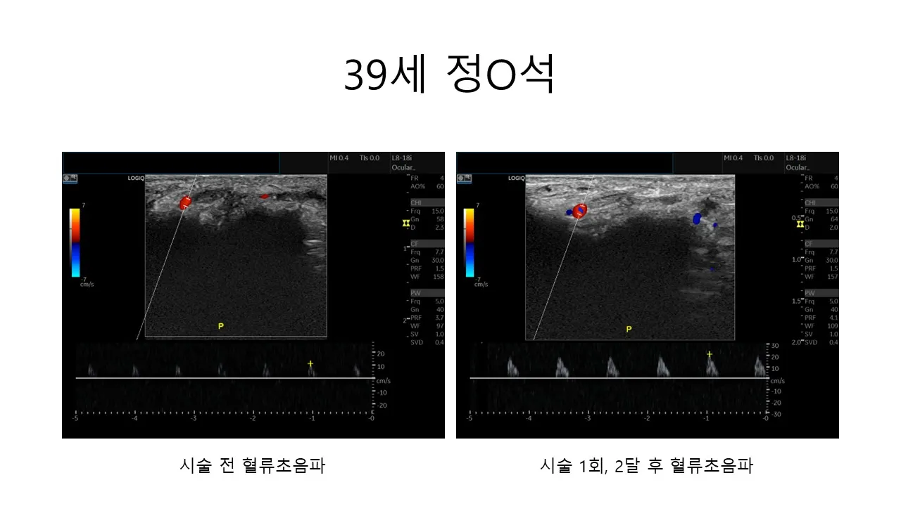 발기부전 시술 전후 사진