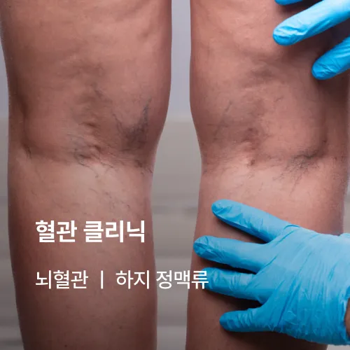 혈관 클리닉: 뇌혈관, 하지 정맥류